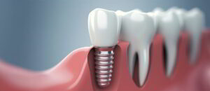 60 - Case Study Single Dental Implant Procedure