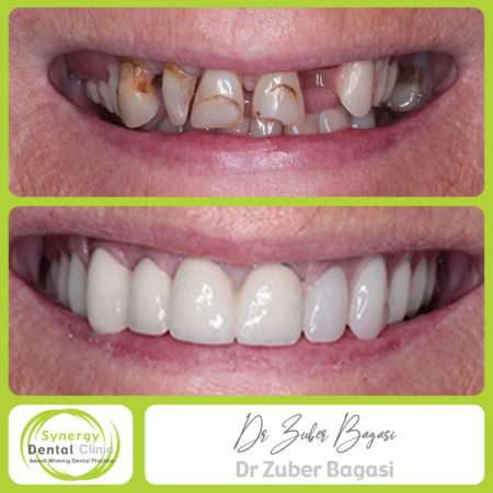 Precision Denture Precision Denture
