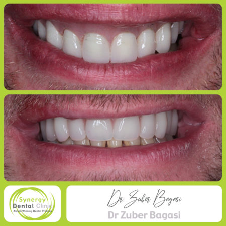 Same Day Dental Implants Same Day Dental Implants