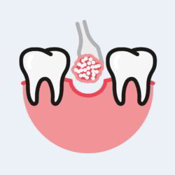 Dental Bone Grafting