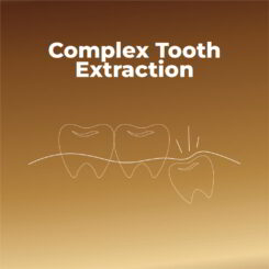 Complex tooth extractions