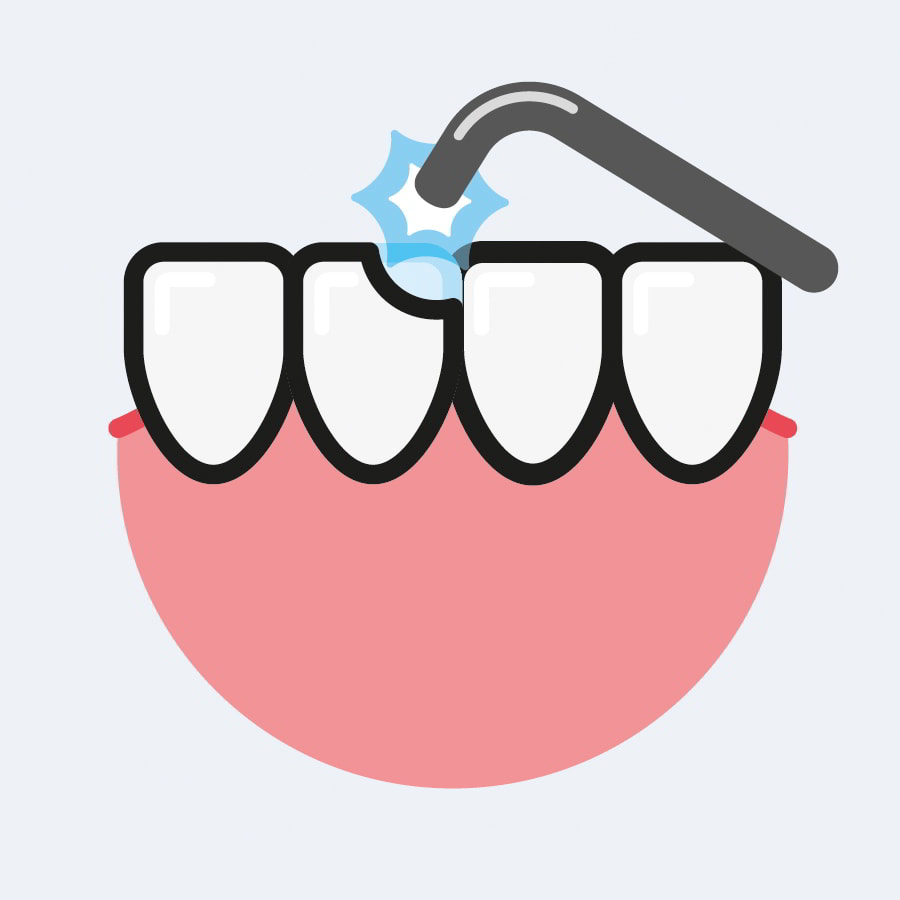 Composite Bonding