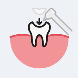 Dental Inlay