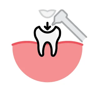 Inlays Dental Fillings
