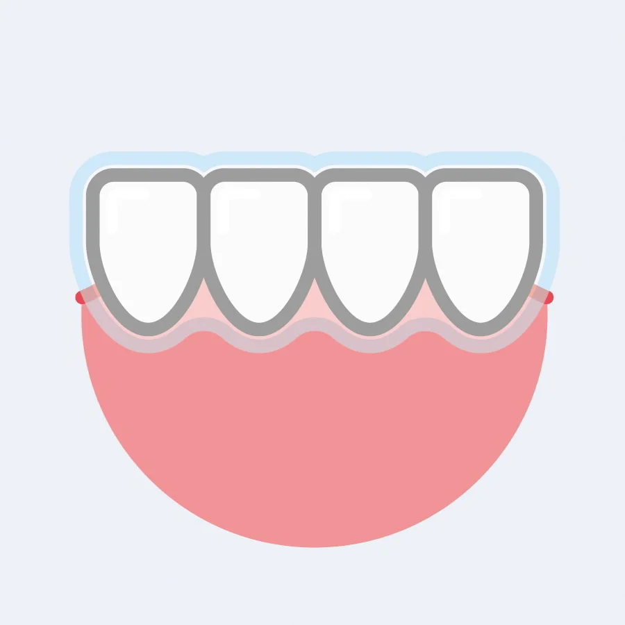 Discounted Invisalign®for SmileDirect Patients