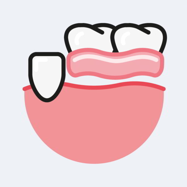 Partial Dentures 1-3
