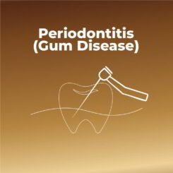 Periodontitis (Gum Disease)