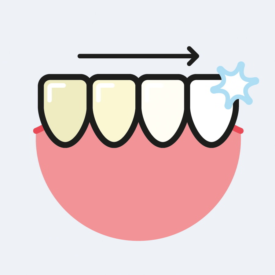 Teeth Whitening