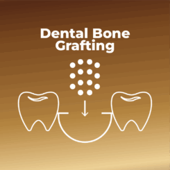Dental Bone Grafting