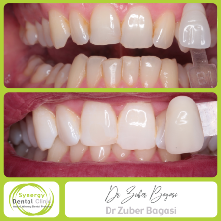 Teeth Whitening Teeth Whitening