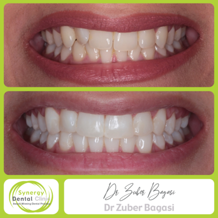 Invisalign Clear Braces Invisalign Clear Braces