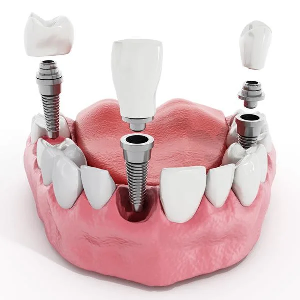 Dental Implants Synergy Dental Clinic