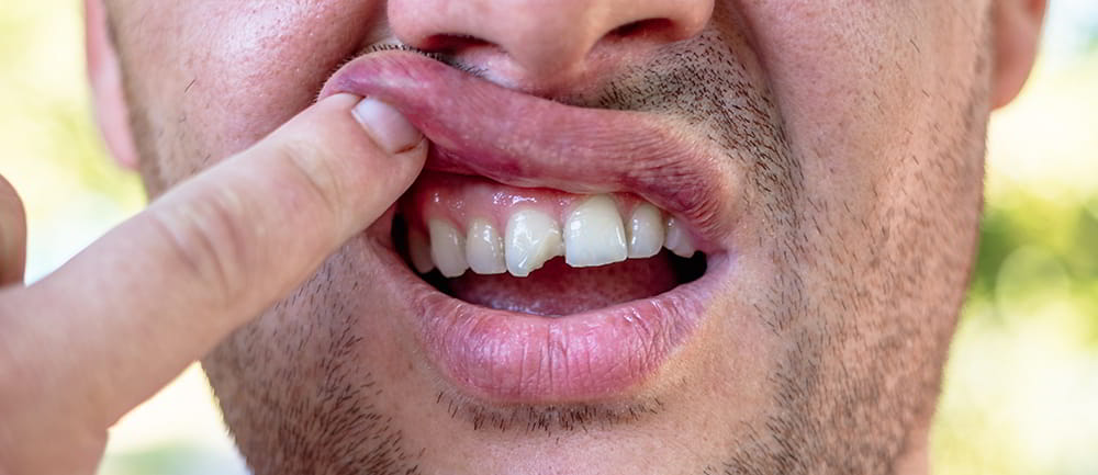 59 - Help on Chipped Teeth