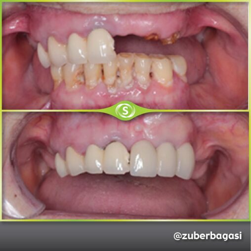 3 Unit Dental Implant Bridge - Dr. Zuber Bagasi • Synergy Dental Clinic