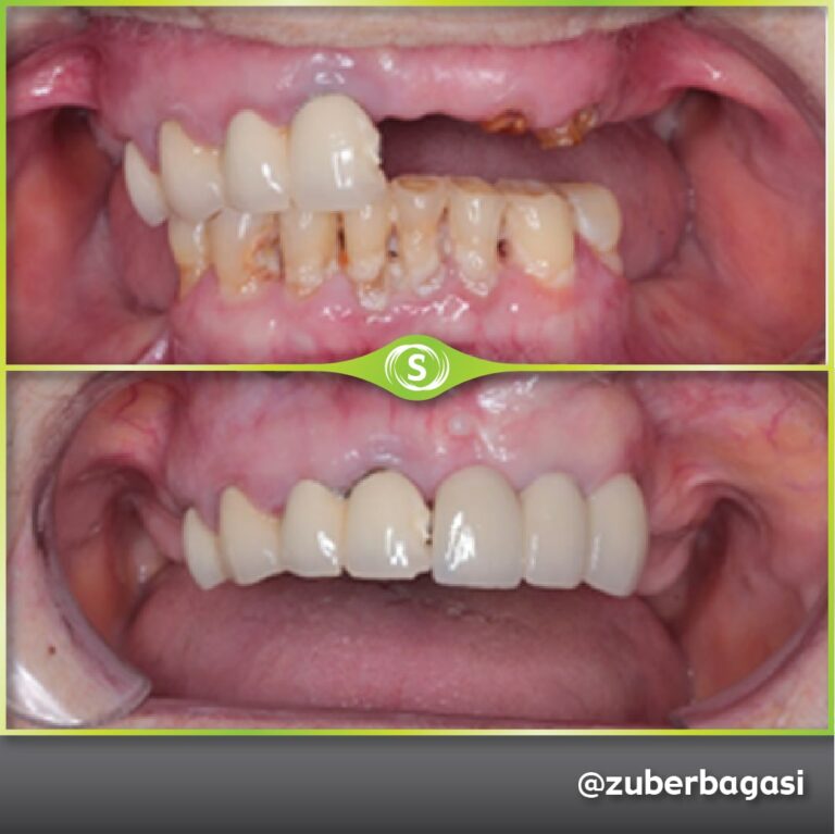 3 Unit Dental Implant Bridge - Dr. Zuber Bagasi