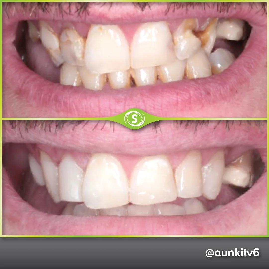 Composite Bonding - Dr. Aunkit Vaja