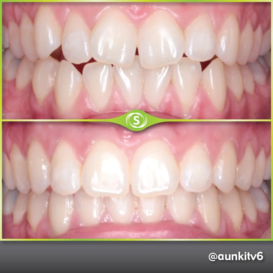 Invisalign - Composite Bonding - Dr. Aunkit Vaja