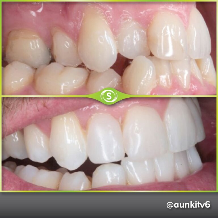 Invisalign, Composite Bonding, Teeth Whitening - Dr. Aunkit Vaja