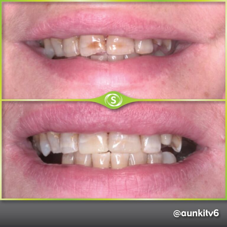Composite Bonding, Teeth Whitening - Dr. Aunkit Vaja