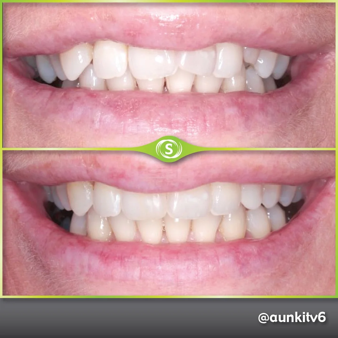 Invisalign, Composite Bonding - Dr. Aunkit Vaja