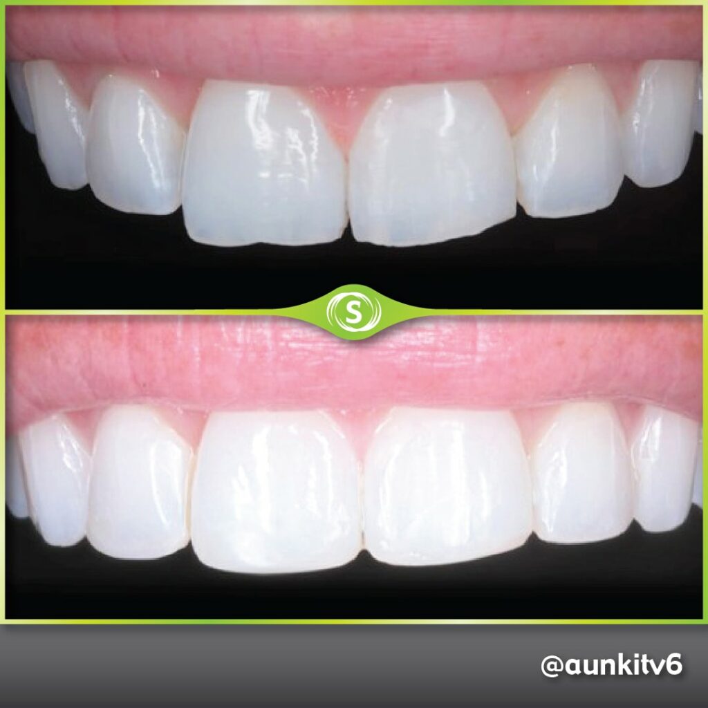 Composite Bonding + Teeth Whitening - dr. Aunkit Vaja
