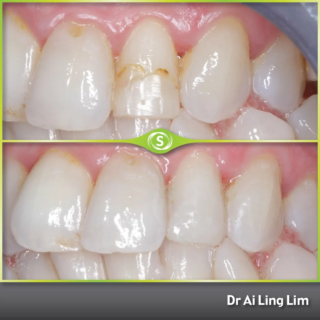 Composite Bonding - Dr. Ai Ling Lim