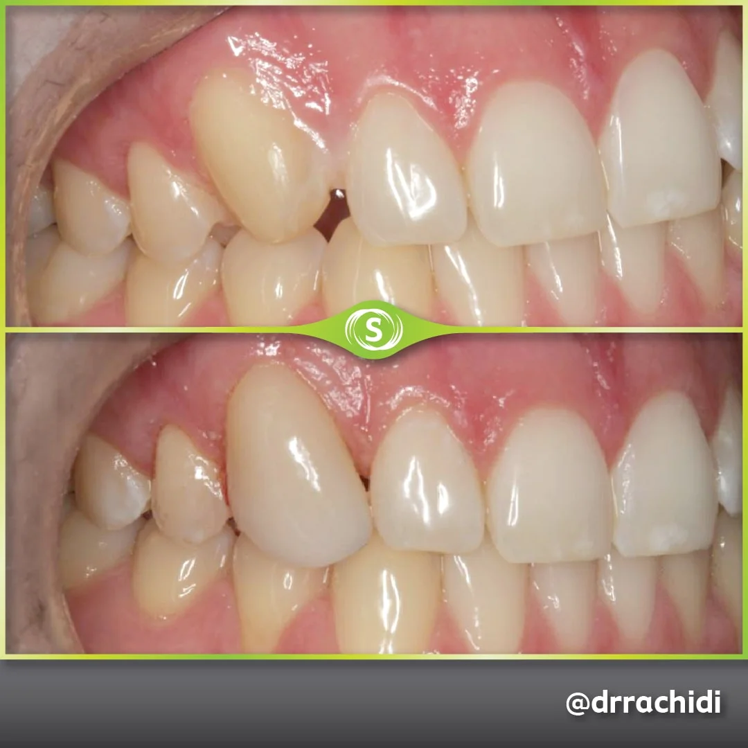 Composite Bonding - Dr. Karim Rachidi