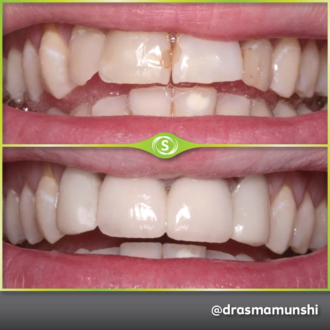 Cosmetic Dentistry - Dr. Asma Valli