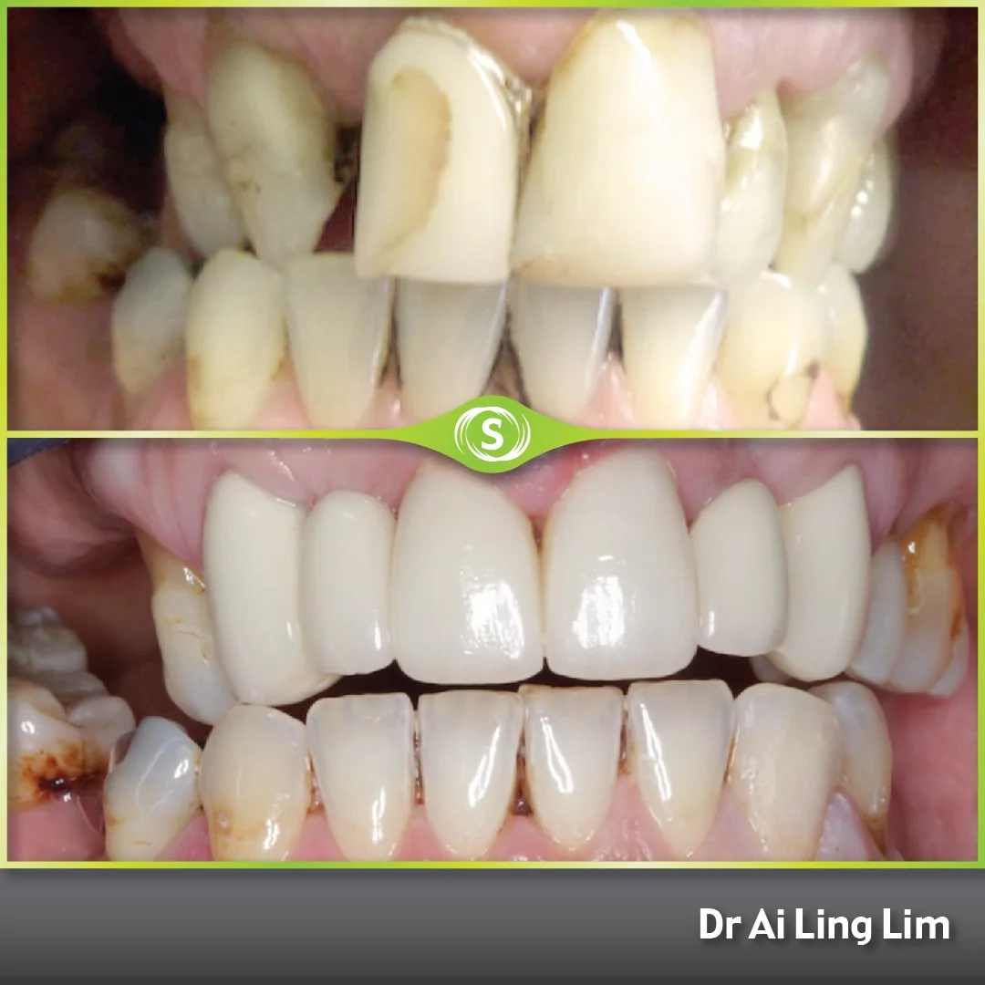 Cosmetic Dentistry - Crowns and Bridges - Dr. Ai Ling Lim