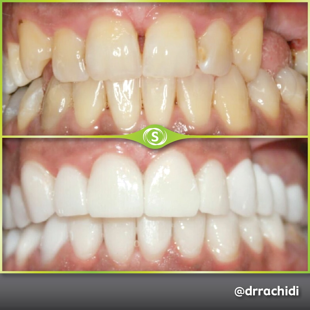 Dental Veneers E-max Zirconia - Dr. Karim Rachidi