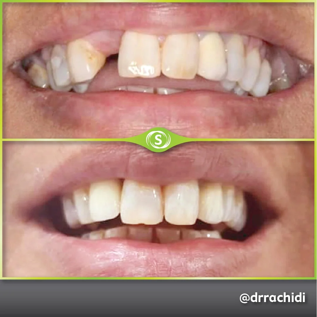 B&A Implant Dr. Karim Rachidi