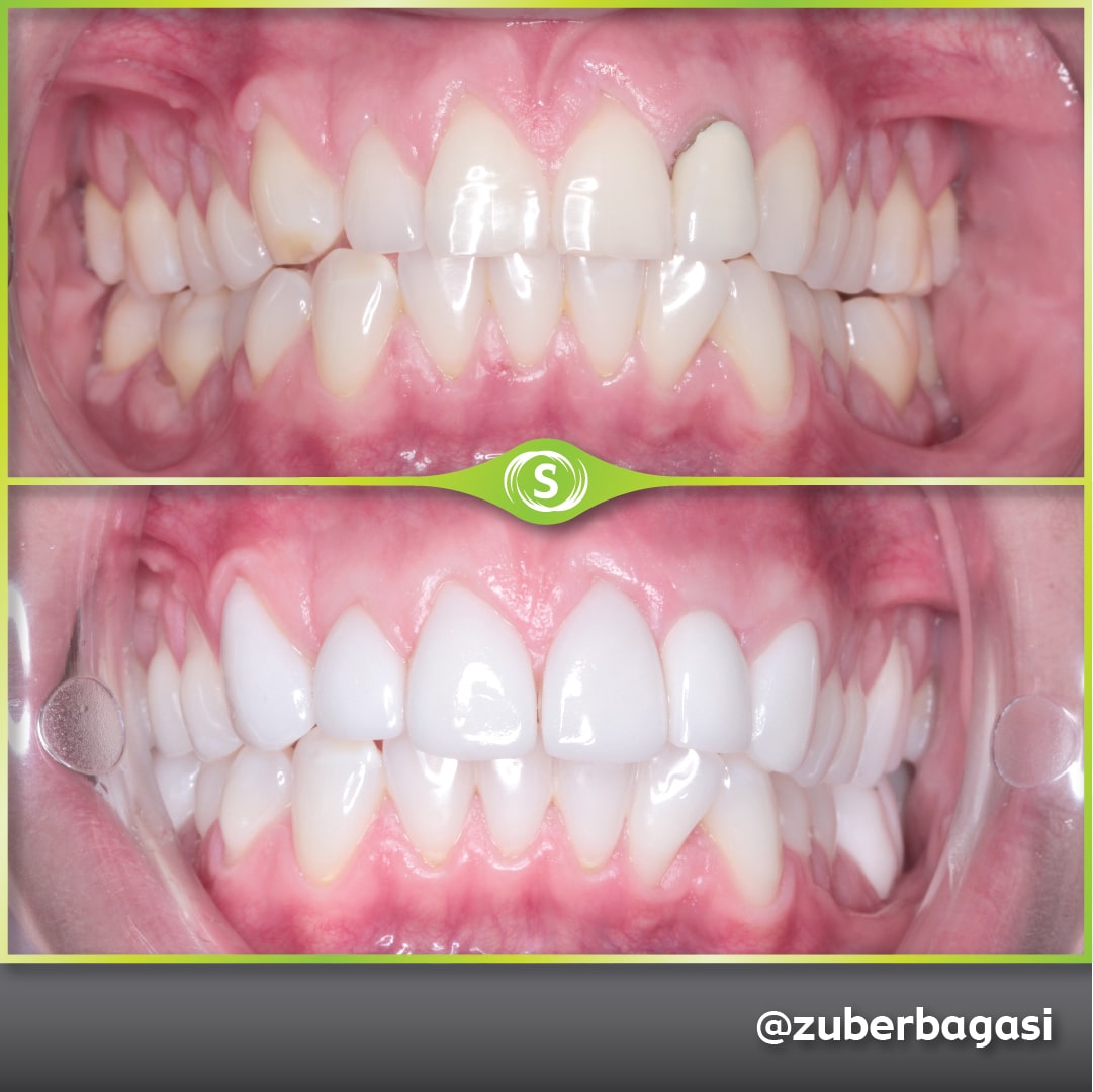 B&A Implant Veneers ZB 1a-min