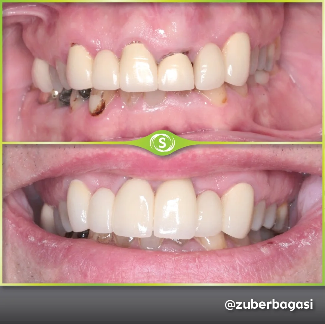 Dental Implants 6 Unit Bridge - Dr. Zuber Bagasi