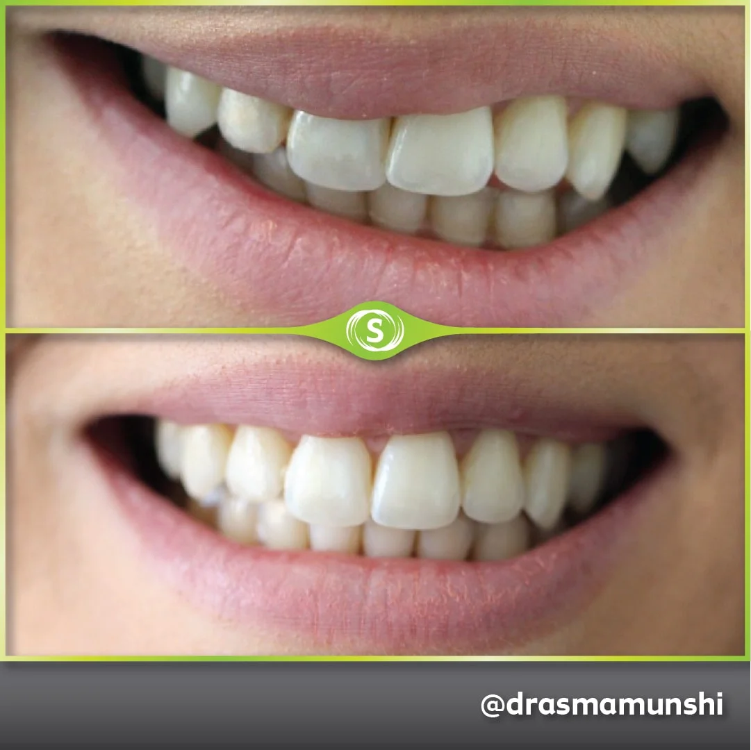 B&A Invisalign AV 2-min