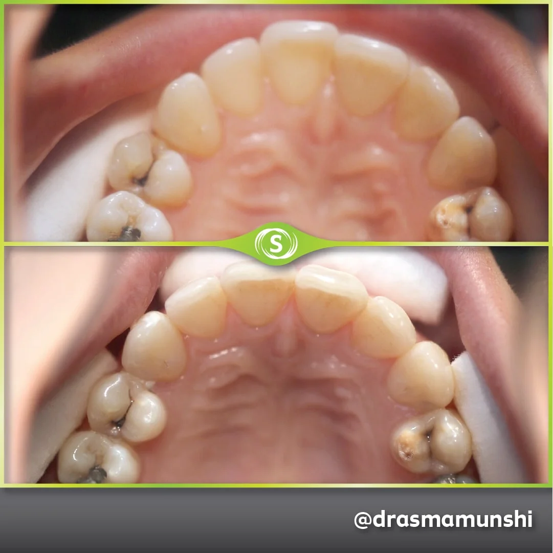 B&A Invisalign AV 3-min