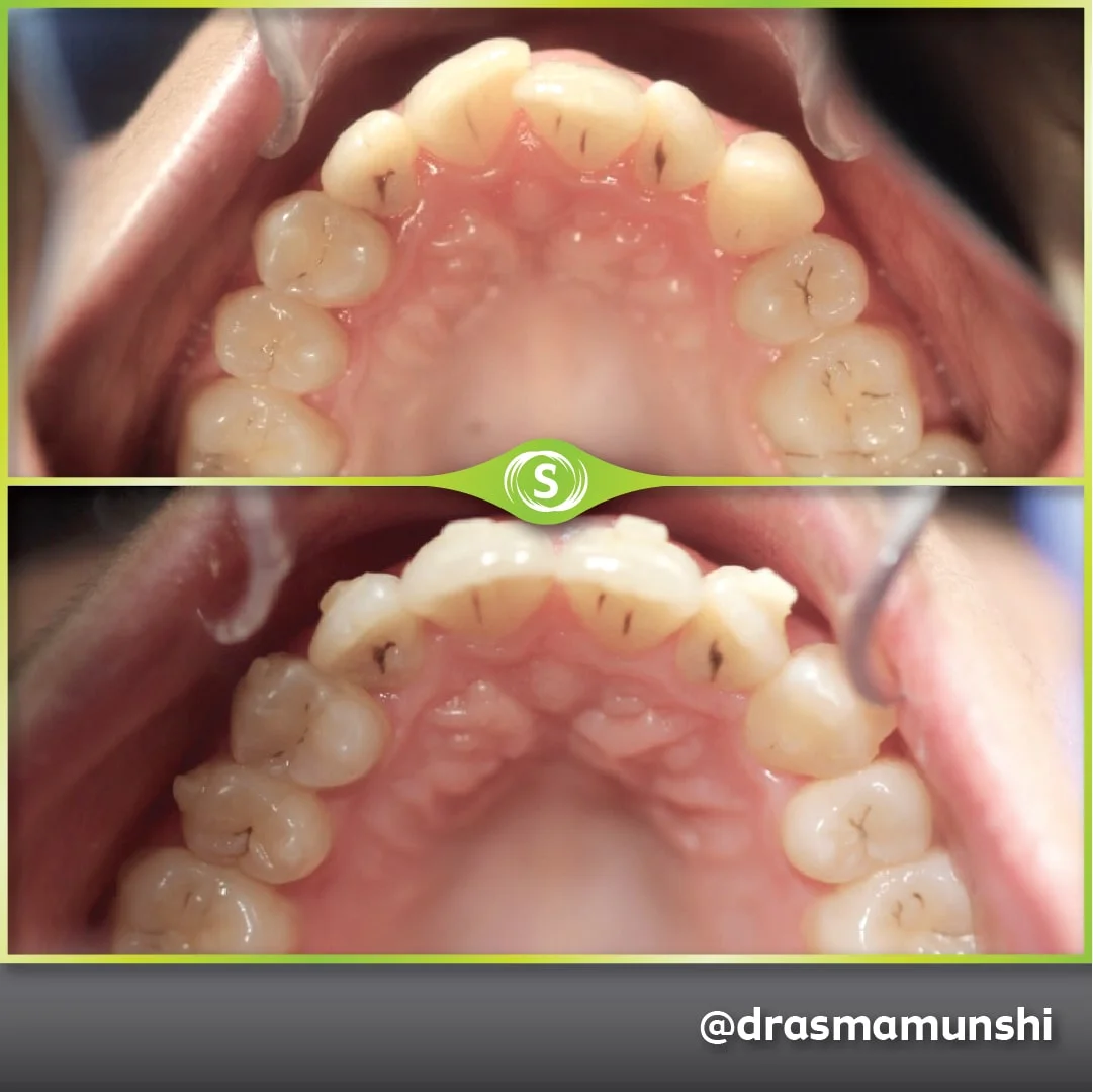 B&A Invisalign AV 4-min