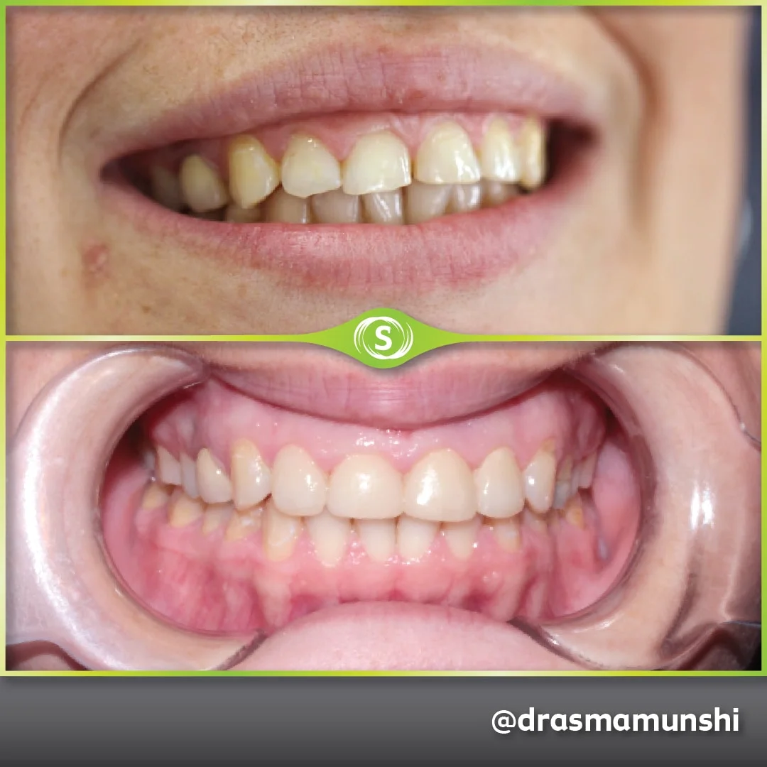 Cosmetic Dentistry - Veneers - Dr. Asma Valli
