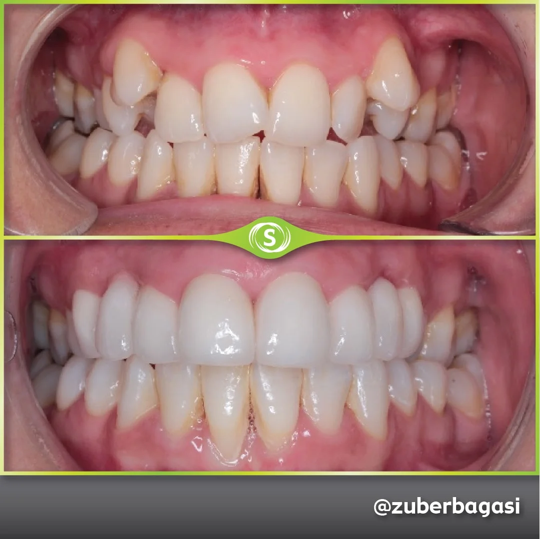 B&A Zirconia Bridge ZB 1a-min