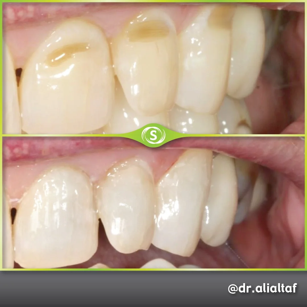 Composite Bonding - Dr. Ali Altaf
