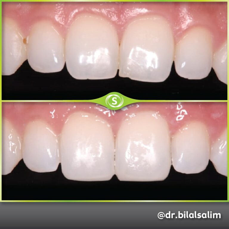 Composite Bonding - Dr. Bilal Salim