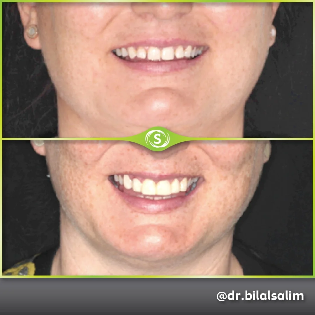 Composite Bonding - Dr. Bilal Salim