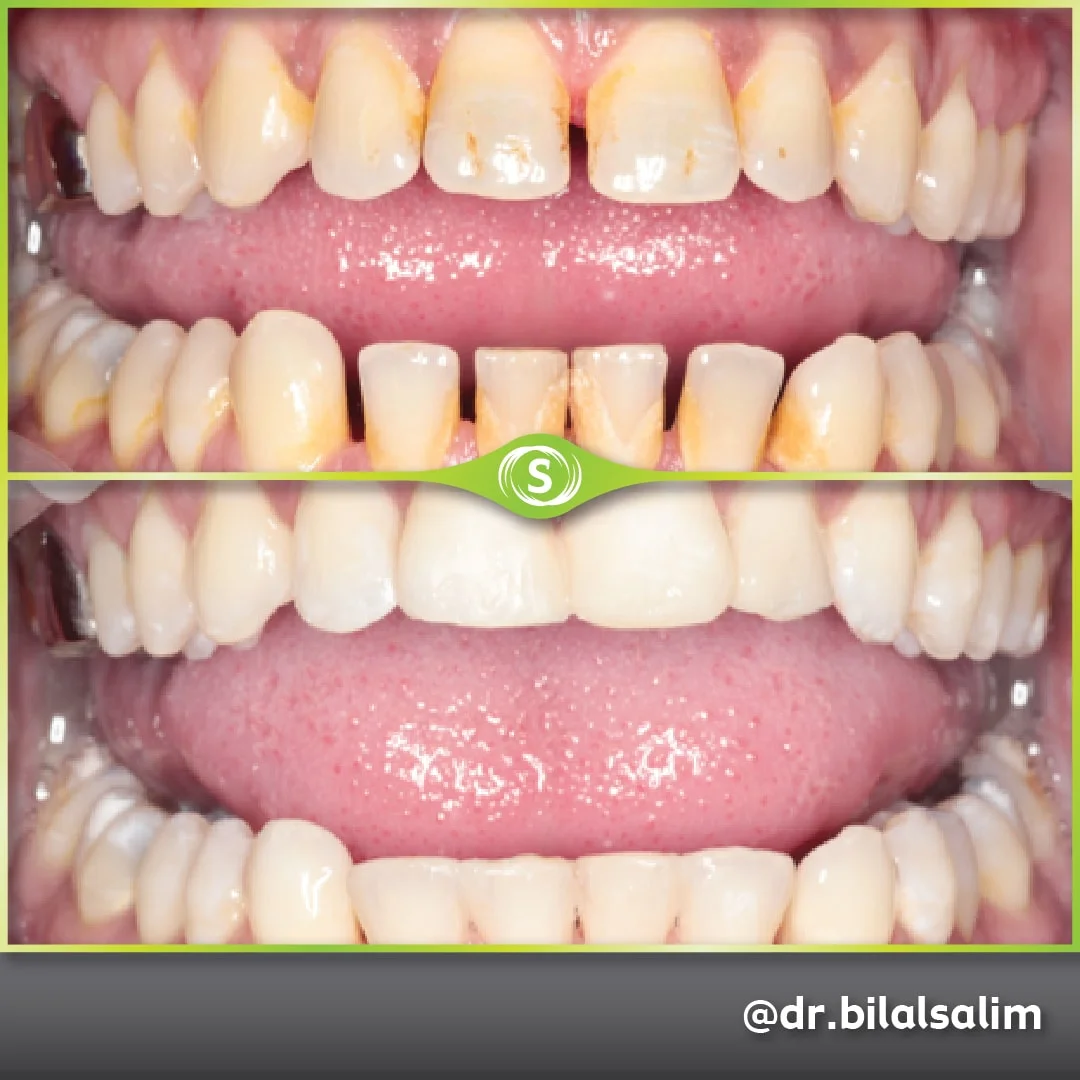 Composite Bonding - Dr. Bilal Salim