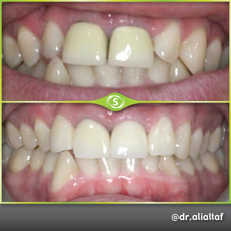Dental Crowns - Dr. Ali Altaf