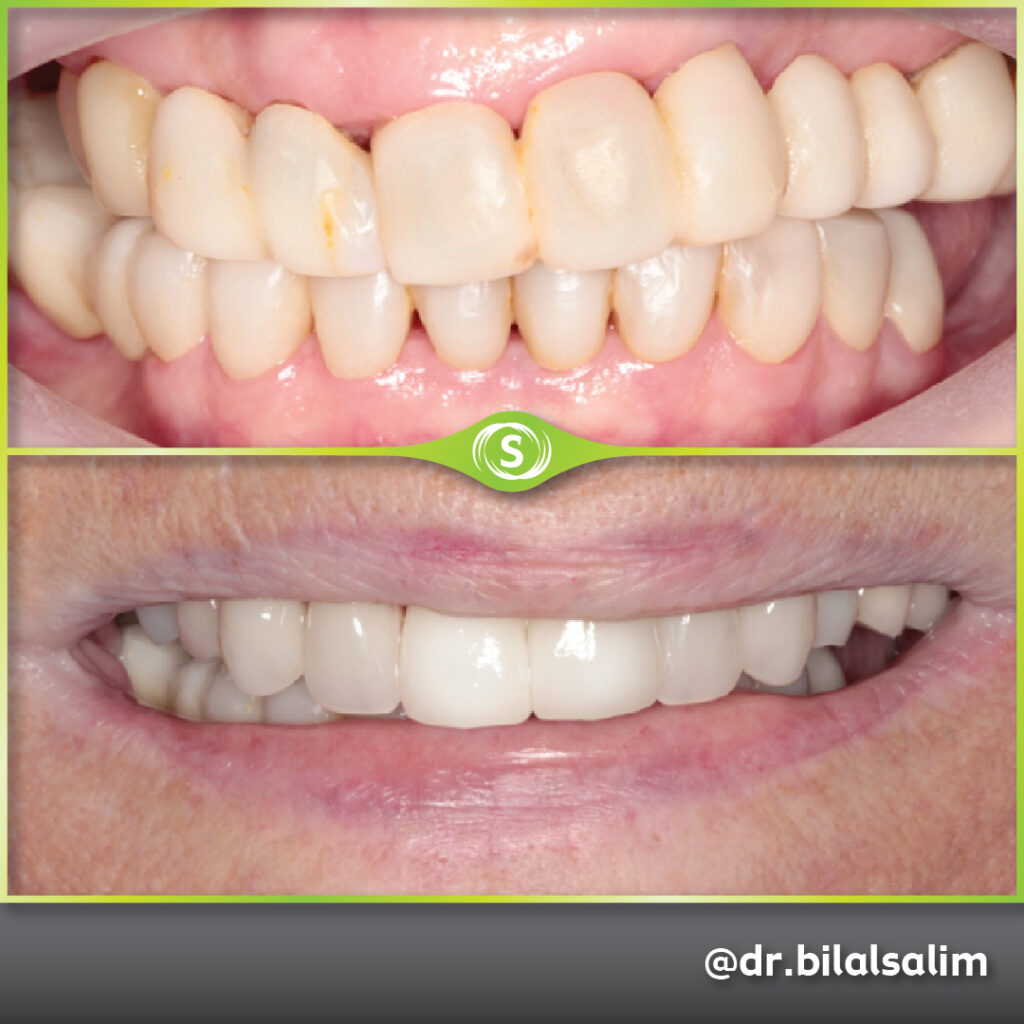 Dentures and Dental Crowns - Dr. Bilal Salim