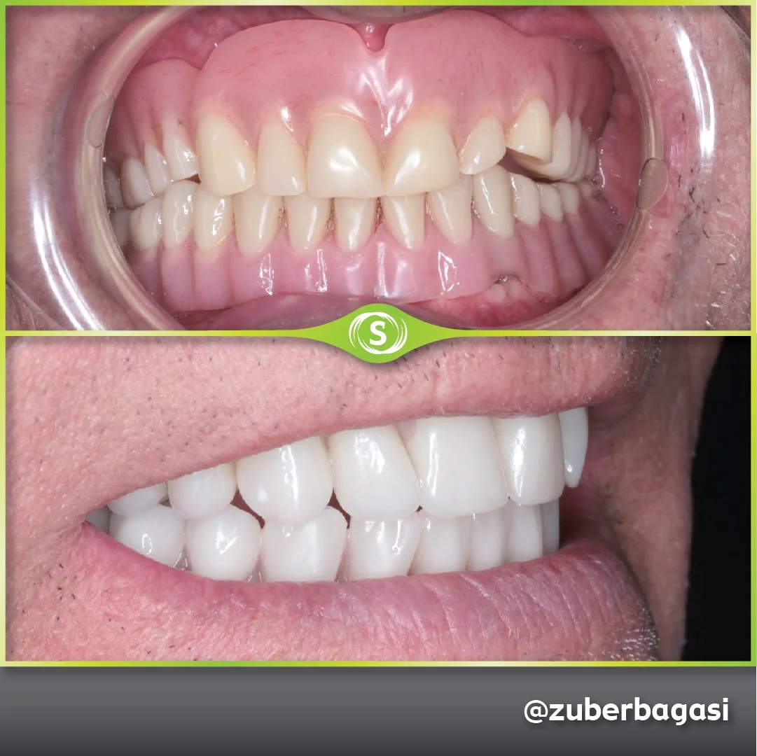 https://synergydental.org.uk/before-and-after/case-study-same-day-implants-case-study/
