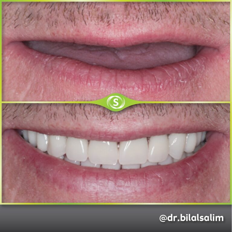B&A Gold Acrylic Dentures BS-min