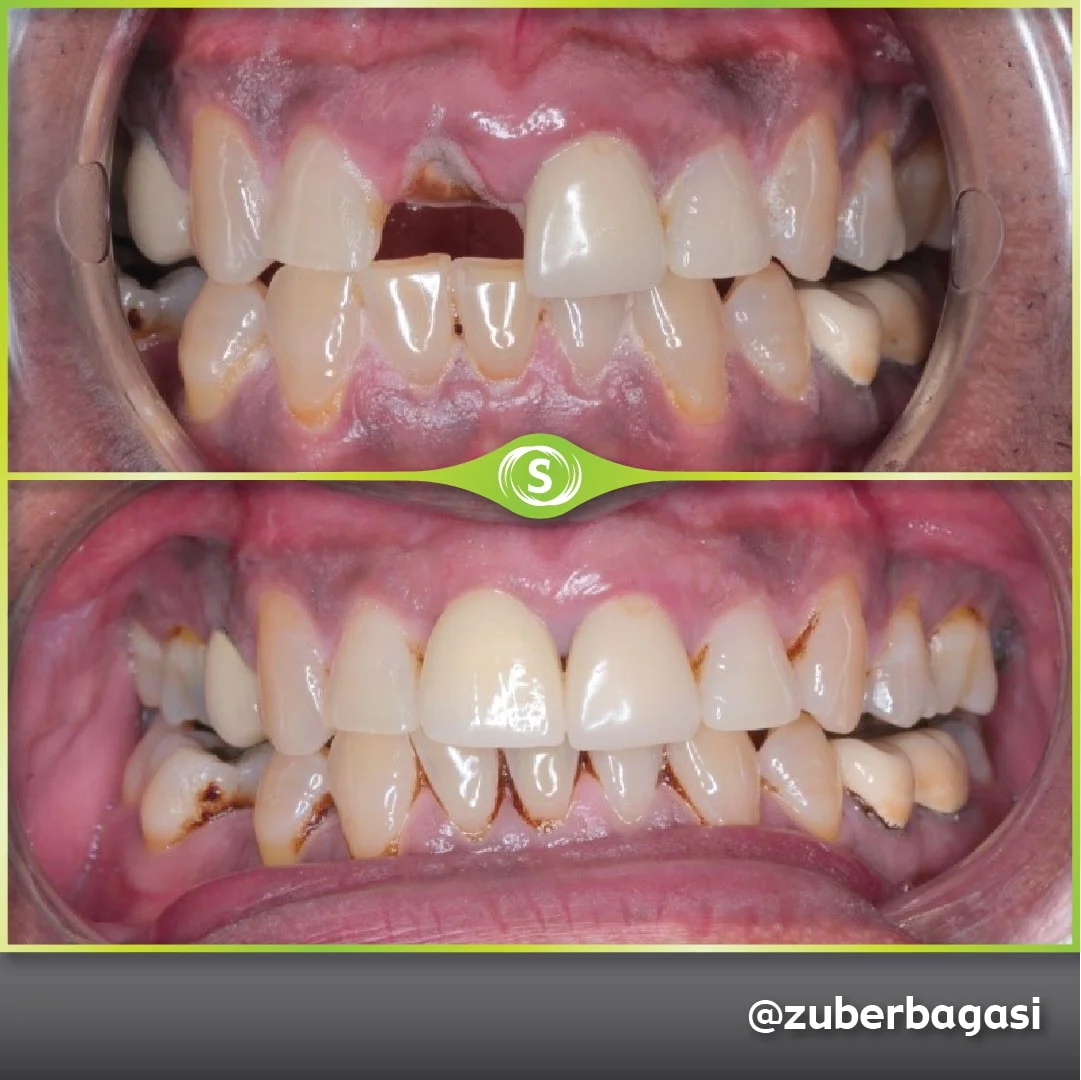 Dental Implants - Single Front Implant - Dr. Zuber Bagasi