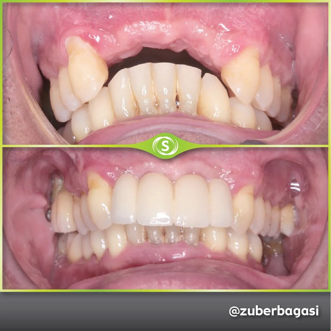 B&A Implants ZB 9b-min