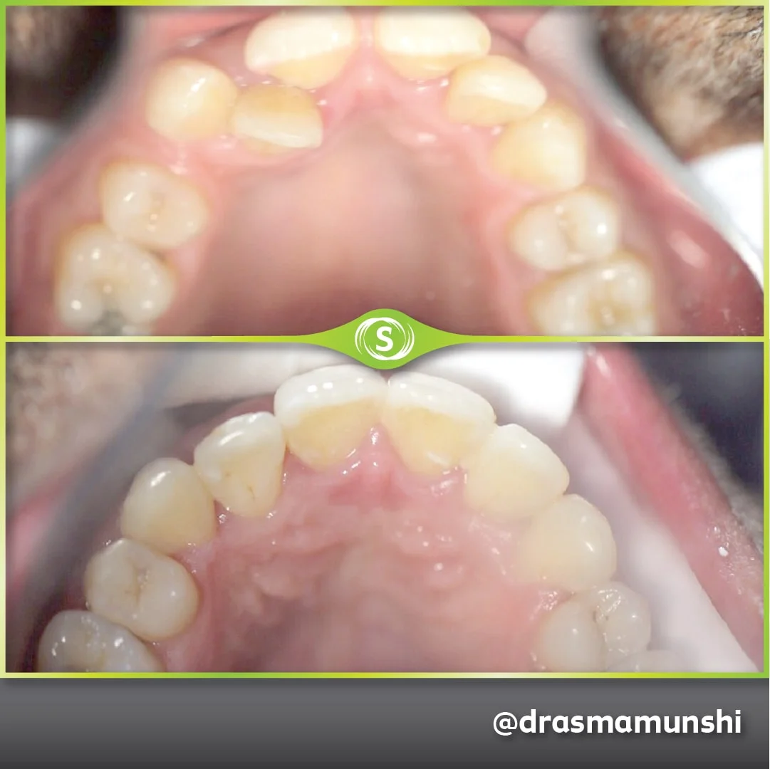 B&A Invisalign AV 1c-min