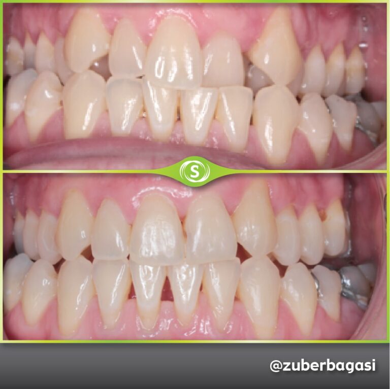 https://synergydental.org.uk/before-and-after/invisalign%e2%93%87-clear-braces-case-11-3/